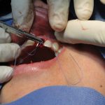Implants dentaire
