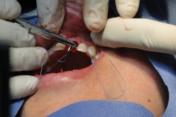 Implants dentaire
