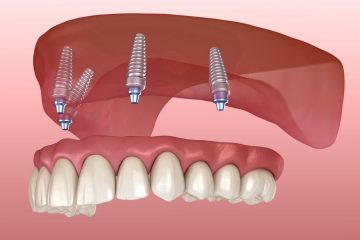 implants dentaires all on 4